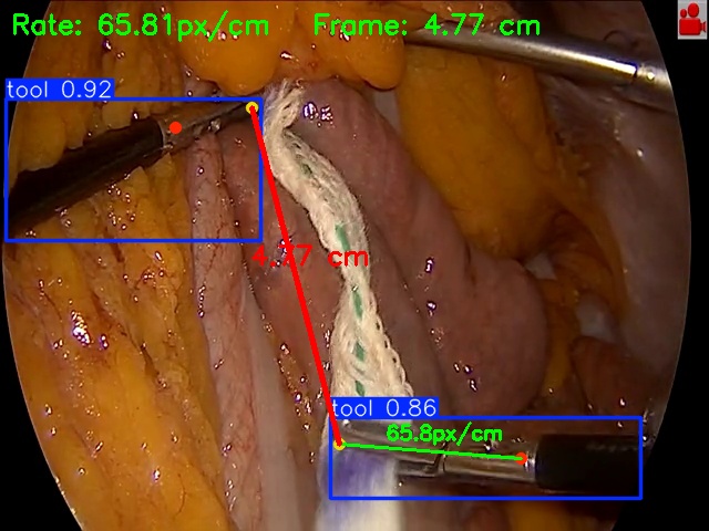 Computer Vision–Based Intraoperative Measurement of Biliopancreatic Limb Length